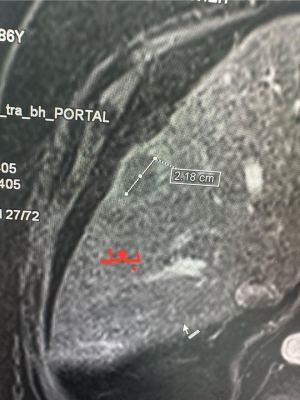 أول عملية كي حراري لورم خبيث في الكبد في مركز الأورام العسكري