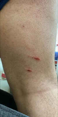 شاب يتعرض لهجوم من كلاب ضالة بالسلط ومطالب بالتصدي للظاهرة