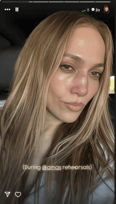 جينيفر لوبيز تنشر صور إصابتها وتكشف حالتها الصحية.. قبل حفل «جوائز الموسيقى الأمريكية»