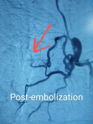 إنقاذ مريض من نزيف رئوي حاد بالقسطرة في إنجاز طبي بالأردن