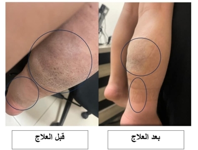 علاج ورم نادر بالأشعة لطفل في مستشفى الملك المؤسس