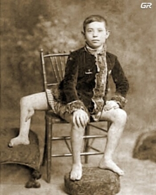 بثلاث أرجل وجهازين تناسليين.. تعرفوا إلى قصة فرانك لينتيني