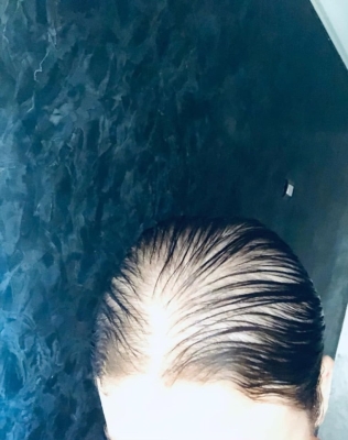 صورة صادمة.. ممثلة مصرية تعلن إصابتها بالصلع بعد حقنها دون إذنها