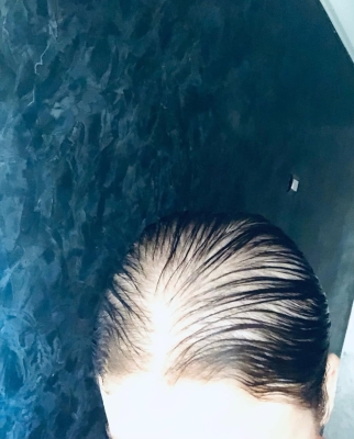 بعد تساقط شعرها... ما هو مرض الفنانة رحمة حسن؟