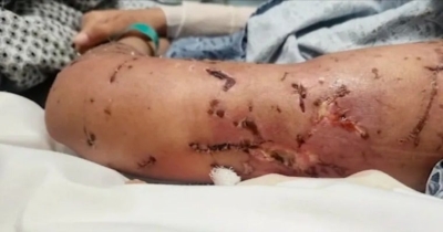 أميركا.. مراهقة تتعرض لهجوم دموي من 10 كلاب - صور