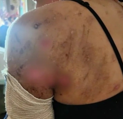 أميركا.. مراهقة تتعرض لهجوم دموي من 10 كلاب - صور