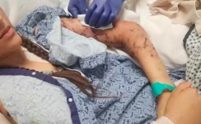 أميركا.. مراهقة تتعرض لهجوم دموي من 10 كلاب - صور