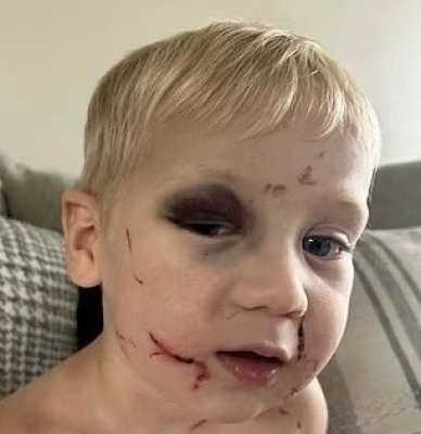 كدمات وخدوش مروعة.. موظفة حضانة تعتدي بوحشية على رضيع في يومه الأول