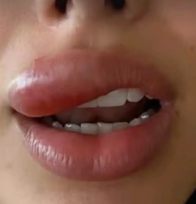 صديقة نيمار تظهر بوجه متورم وتكشف عن (إصابة خطيرة)