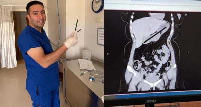 بسبب اضطراب نادر.. استخراج قلمين من معدة شابة تركية! (صور)