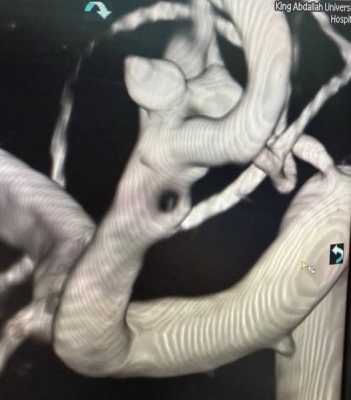 عملية دقيقة تنقذ حياة مريض من نزيف دماغي حاد في مستشفى الملك المؤسس