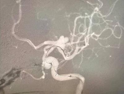 عملية دقيقة تنقذ حياة مريض من نزيف دماغي حاد في مستشفى الملك المؤسس