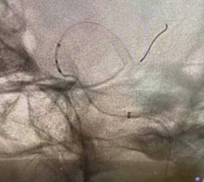 عملية دقيقة تنقذ حياة مريض من نزيف دماغي حاد في مستشفى الملك المؤسس