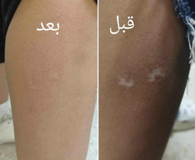 الأردن .. مستشفى الامير هاشم يجري عمليات زراعة خلايا صبغية لمرضى البهاق - صور