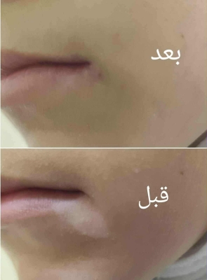 الأردن .. مستشفى الامير هاشم يجري عمليات زراعة خلايا صبغية لمرضى البهاق - صور