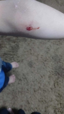 طفل يتعرض لعضة كلب ضال في منتزه للأطفال بالكرك - صور