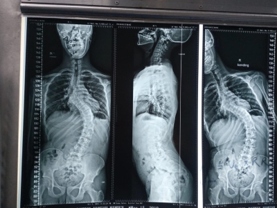 إنجاز طبي في مستشفى الأمير حمزة: تصحيح جنف حاد بالعمود الفقري