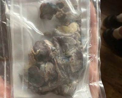 صور مُفزعة.. هكذا دمر (التدخين الإلكتروني) رئة مراهق لم يتجاوز 17 عاماً