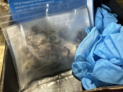 صور مُفزعة.. هكذا دمر (التدخين الإلكتروني) رئة مراهق لم يتجاوز 17 عاماً