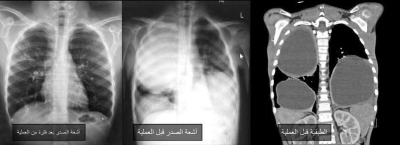 جراحة نوعية لاستئصال أكياس كلابية من رئتي طفل بمستشفى الجامعة