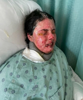 خسرت جلدها وعينيها.. دواء شائع يحرق جسد امرأة ويصيبها بالعمى - صور