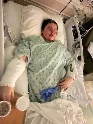 خسرت جلدها وعينيها.. دواء شائع يحرق جسد امرأة ويصيبها بالعمى - صور