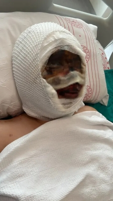 سكب الأسيد على رأسها وهي مقيدة.. تركي يمحو ملامح زوجته ويتركها تصارع الموت