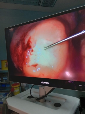 إنجاز طبي بالخدمات الطبية: استئصال أكياس رئوية لطفلتين بالمنظار لأول مرة