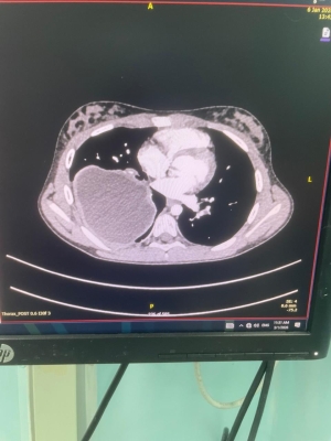 إنجاز طبي بالخدمات الطبية: استئصال أكياس رئوية لطفلتين بالمنظار لأول مرة