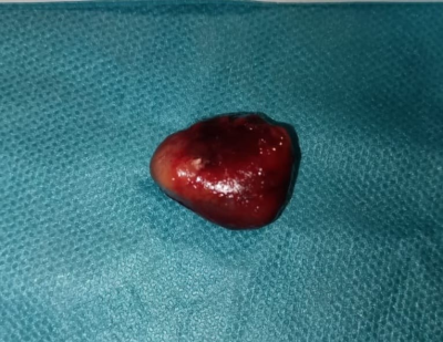 استئصال غدة جارة درقية بتقنية قياس الهرمون أثناء العملية في مستشفى الملك عبدالله المؤسس