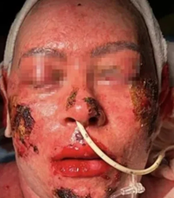 مضاد اكتئاب شائع يتسبب في تآكل جلد امرأة بنسبة 55%