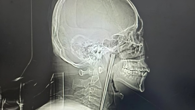 تفاصيل حالة طبية نادرة لرجل ابتلع عودا معدنيا وظل في حلقه لسنوات - صورة