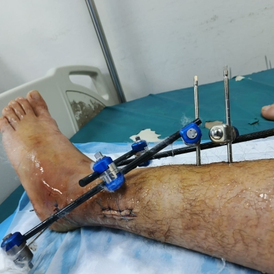 مناشدة إنسانية عبر خبرني لشاب أردني بعد إصابته بكسر في الكاحل - صور فيديو