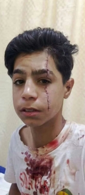 أردني يناشد بعلاج ابنه بعد إصابته بـ27 قطبة في وجهه: (مستقبله ضاع) - صورة