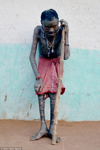 (الرجل الأفعى) يبدل جلده كل 10 أيام