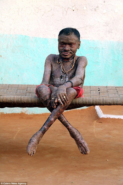 (الرجل الأفعى) يبدل جلده كل 10 أيام