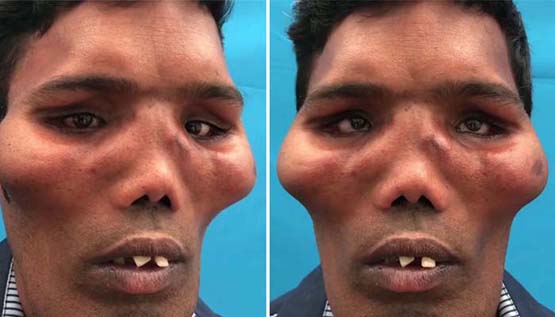إعادة بناء وجه رجل يعاني من مرض نادر -فيديو