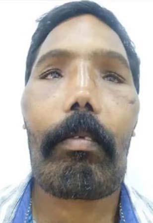 إعادة بناء وجه رجل يعاني من مرض نادر -فيديو