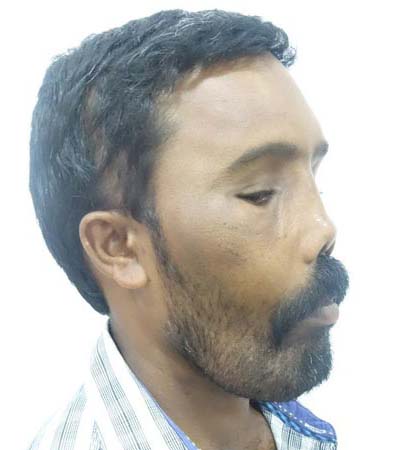 إعادة بناء وجه رجل يعاني من مرض نادر -فيديو