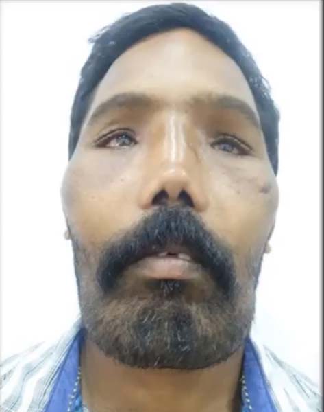 إعادة بناء وجه رجل يعاني من مرض نادر -فيديو