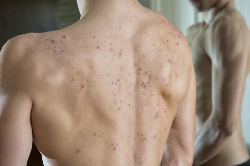 أسباب حبوب الظهر وكيفية التخلص منها