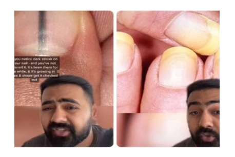 بقع تظهر في الأظافر تدل على الإصابة بالسرطان - صورة 