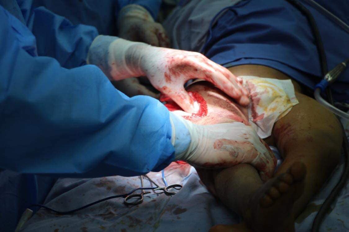 عمليات نوعية ومعقدة للأطفال بمستشفى الأمير هاشم