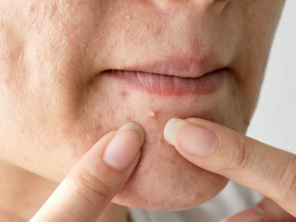 ماهو سبب ظهور الحب المفاجئ  أسباب لن تتوقعيها