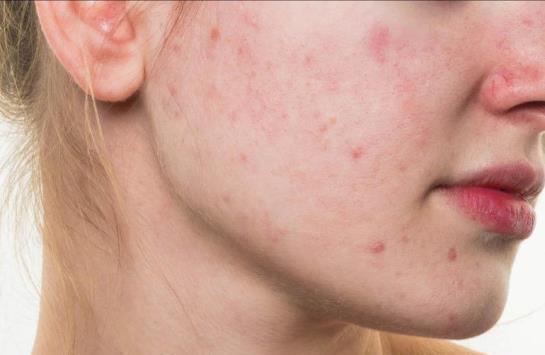 تعرفوا على أعراض مرض حب الشباب