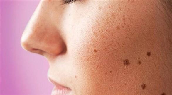  كيف تتخلصين من البقع الصبغية على الوجه