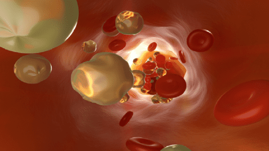 العلامات الأربع لارتفاع نسبة الكوليسترول في الدم