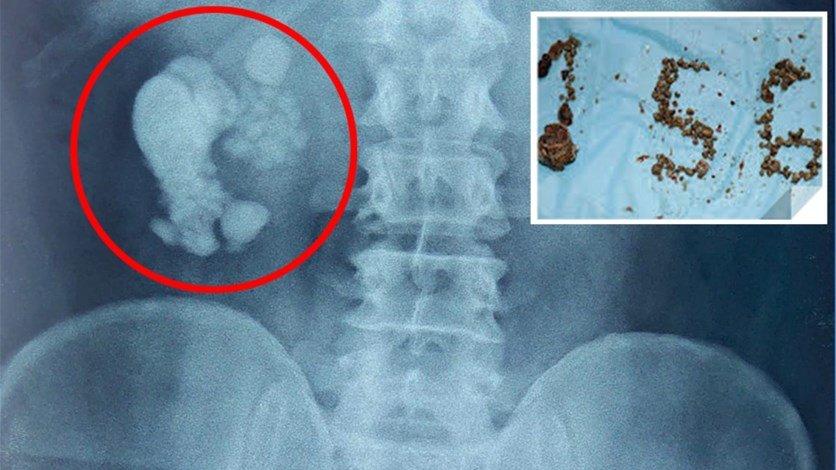 في الهند استخراج 156 حصوة من كلية مريض 