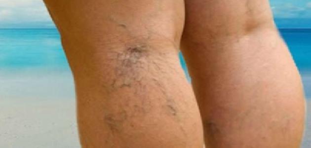 مكون طبيعي يخلصك من الدوالي نهائياً