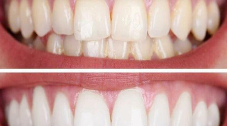 احذر تغير لون اللثة دليل على عرض صحي خطير